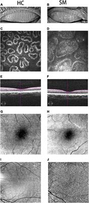 Altered Intrinsic Regional Spontaneous Brain Activity in Patients With Severe Obesity and Meibomian Gland Dysfunction: A Resting-State Functional Magnetic Resonance Imaging Study